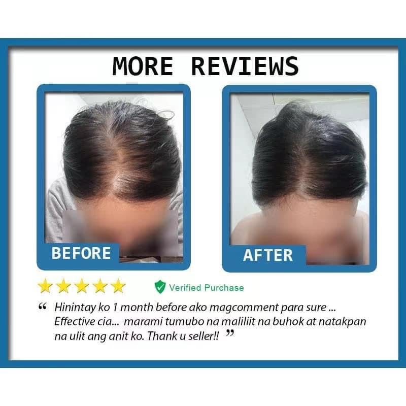 Minoxidil Hair Growth spray